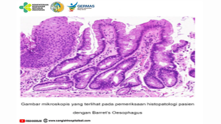 Apa  Barrett’s oesophagus (BE)?